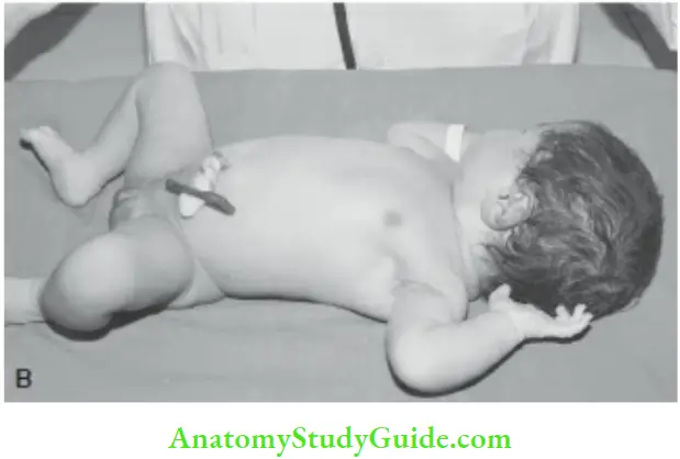 Examination Of A Newborn Baby Arm Recoil Briskly Recoils Or Flexes In A term Infant