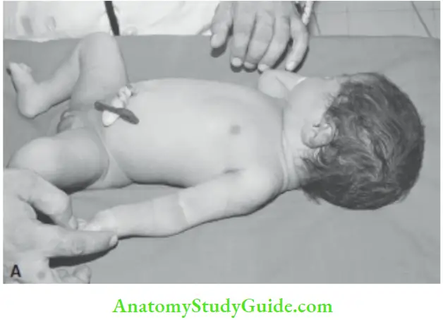 Examination Of A Newborn Baby Arm Recoil The Arm Is Extended And Brought close To The Trunk
