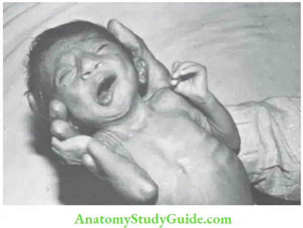 Examination Of A Newborn Baby Asymmetric Crying facies With hypoplasia Of The Depressor Anguli Oris Muscle On The Left Side