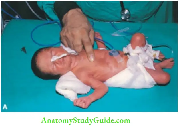 Examination Of A Newborn Baby Balnch The Skin Of Upper Chest By Firm Pressure With A Finger