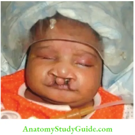 Examination Of A Newborn Baby Bilateral Cleft Lip And Cleft Palate The Infant Had Associated Ventricular Septal Defect