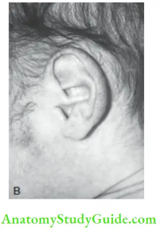 Examination Of A Newborn Baby Ear Cartilage Ear In a PAttern Baby Ear Is Soft Flat And Poorly Formed With No Or Minimal Recoil