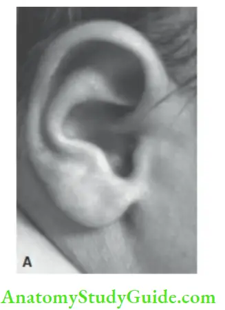 Examination Of A Newborn Baby Ear Cartilage Ear Is Firm With Cartilage And Well Shaped In Term Infant