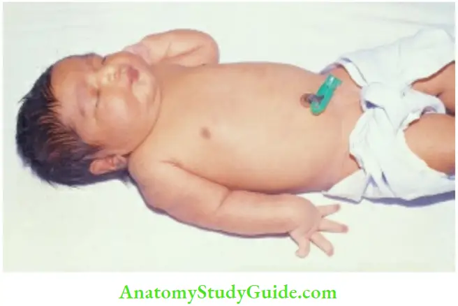 Examination Of A Newborn Baby Erb's palsy On The Right Side In A Large