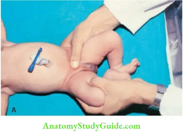 Examination Of A Newborn Baby Examination For Assessment Of Congenital Dislocation Of Right Hip