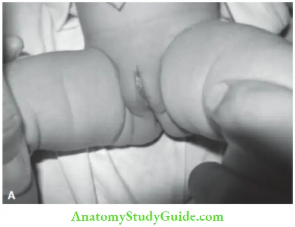 Examination Of A Newborn Baby Female Genitals Labia Majora Completely Cover The Labia Minora In A Term Baby