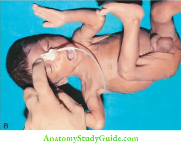 Examination Of A Newborn Baby Glabellar Tap Sudden Closure Of Both The Eyes