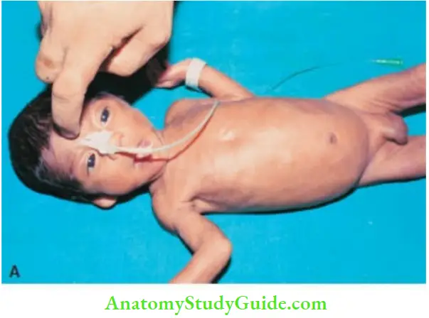 Examination Of A Newborn Baby Glabellar Tap Sudden Tapping Of Nasion