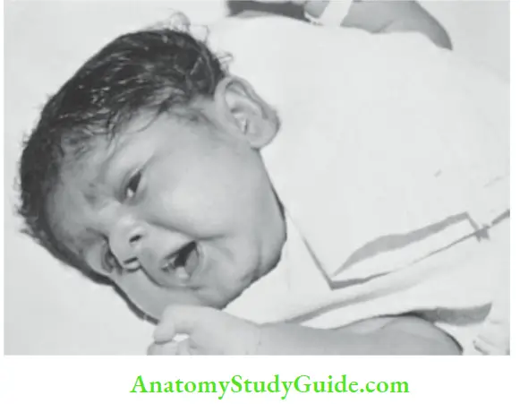 Examination Of A Newborn Baby Hariy Pinna In A Large For Dates Baby Of A Diabetic Mother