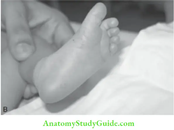 Examination Of A Newborn Baby Is Seen In Preterm Babies