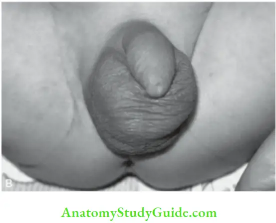 Examination Of A Newborn Baby Male Genitals In APreterm Baby Scrotum Is Small With few Or On Rugosities And Testes Are Undescended