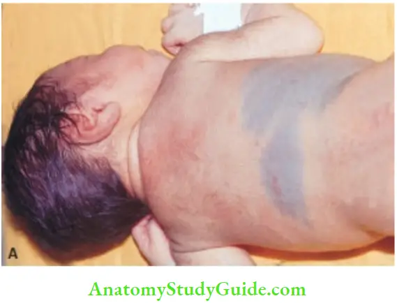 Examination Of A Newborn Baby Mongolian Blue Back Or Spots Sacral Area