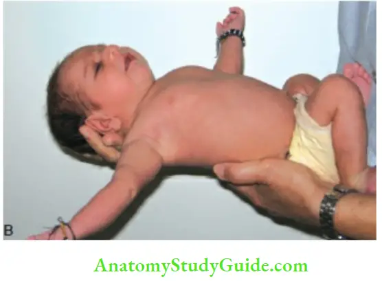 Examination Of A Newborn Baby More Reflex Sudden With Flexion And Abduction Of Upper Limbs