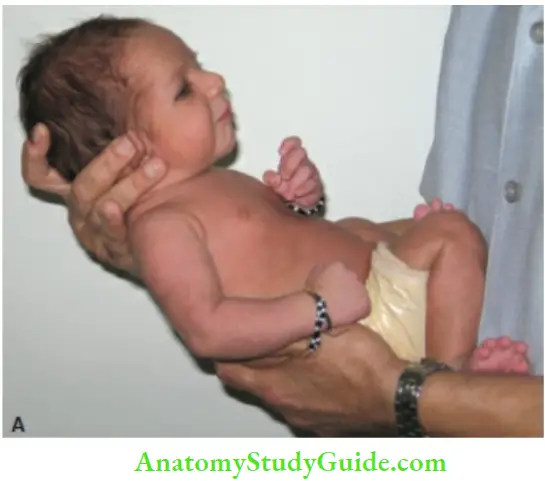 Examination Of A Newborn Baby More Reflex The Baby Is Held Over The Arm And Neck Flexed