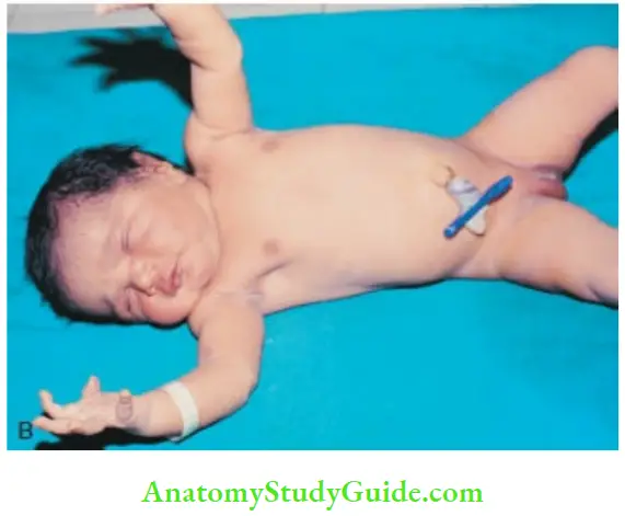 Examination Of A Newborn Baby Moro Reflex The Baby Is Suddenly Released To Elicit The Moro Response