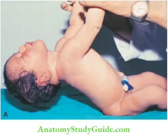 Examination Of A Newborn Baby Moro Reflex The Supine Baby Is Lifted Off The Cot By gently Holding At The Wrists
