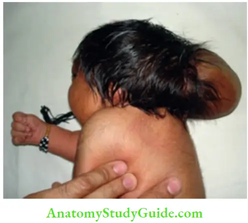 Examination Of A Newborn Baby Occipital Encephalocele In A Neonate