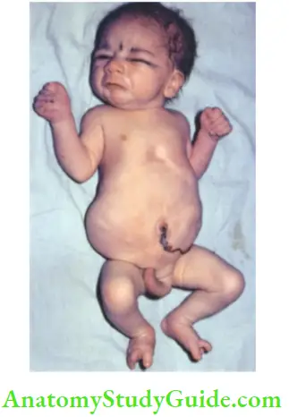 Examination Of A Newborn Baby Prune belly Syndrome