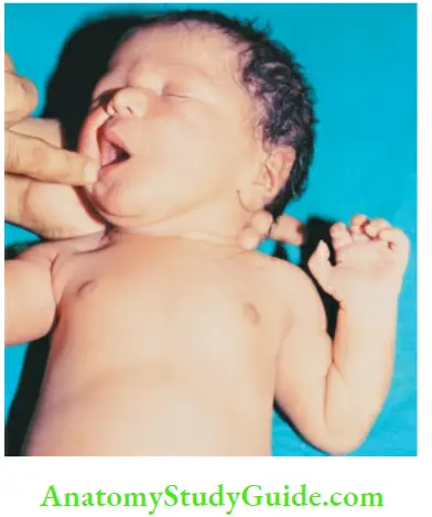 Examination Of A Newborn Baby Root Reflex The baby Opens The Mouth When Cheek Is Touched Near The Angle Of Mouth