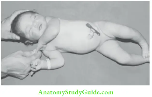 Examination Of A Newborn Baby Scarf Sign The Baby les Supine And Head Is Maintained In The Midline