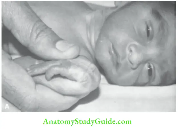 Examination Of A Newborn Baby Squre Window Hand Is Flexed On The Forearm Between Thumb And Index Finger Of Examinear And Angle Between
