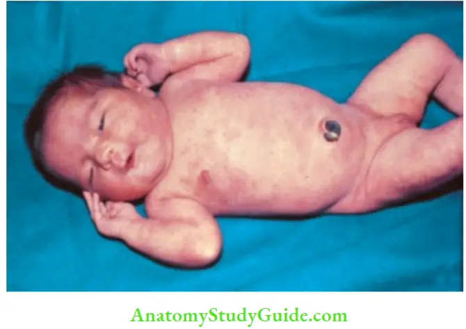 Examination Of A Newborn Baby Toxic Erythema Erythematous Skin Rash With Central apllor Appears On The Face And Trunk In Health term Babies On Second Or Third Day Life