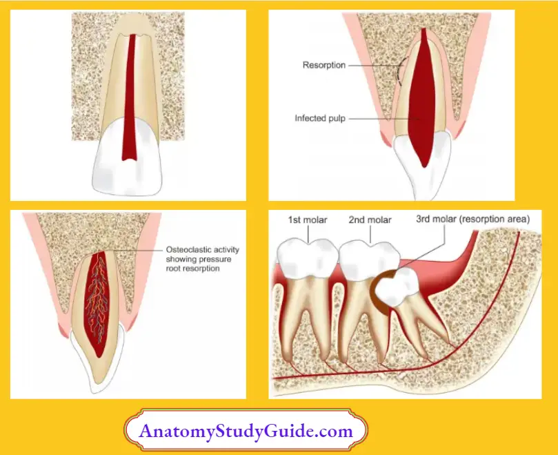 External Inflammatory Root Resorption