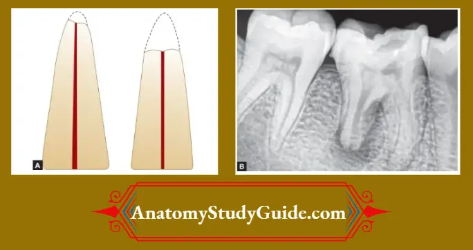 External-resorption-Schematic-Representation-Of-External-Root-Resorption