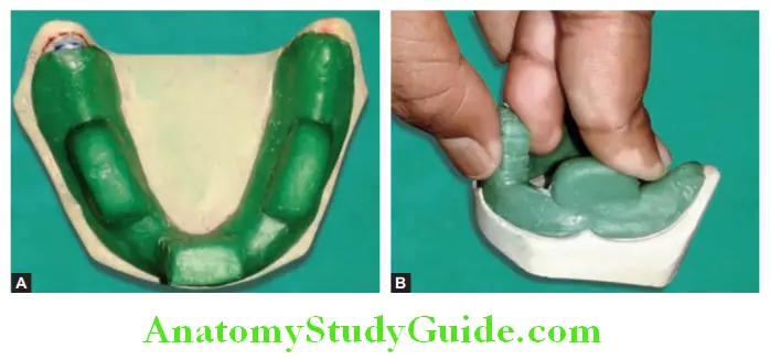 Fabrication Of Custom Tray On Maxillary And Mandibular Primary Casts mandibular custom tray with a handle and two fingers rests