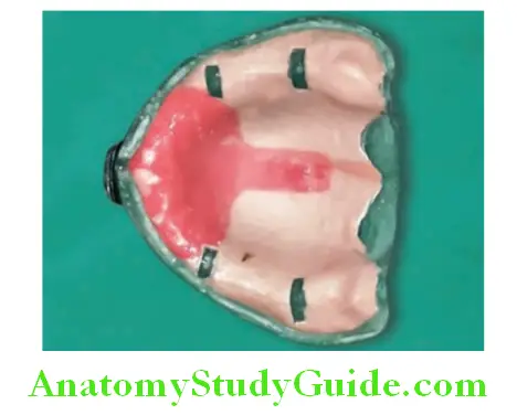 Fabrication Of Custom Tray On Maxillary And Mandibular Primary Casts tissue surface of maxillary impression tray with spacer