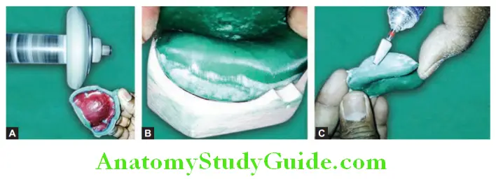 Fabrication Of Custom Tray On Maxillary And Mandibular Primary Casts trimming the excess material beyond the borders