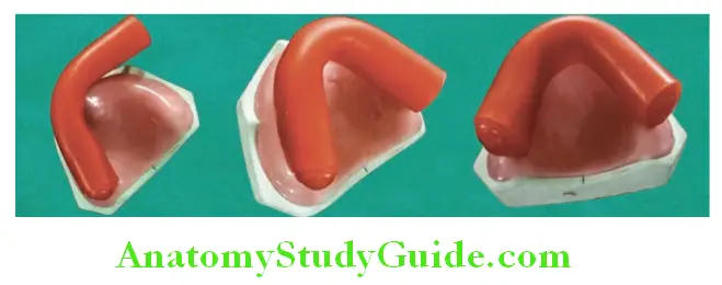 Fabrication Of Occlusal Rims placement of wax roll following the arch shape