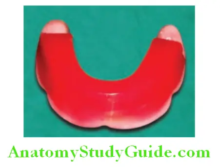 Fabrication Of Occlusal Rims positioning of the wax rim on mandibular ridge
