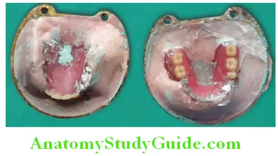 Fabrication Of Removable Partial Denture acrylization of removable partial dentures