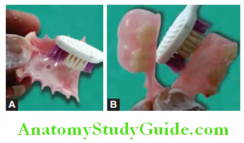 Fabrication Of Removable Partial Denture cleaning with soap water