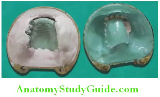 Fabrication Of Removable Partial Denture dewaxing of trial denture