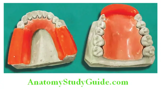 Fabrication Of Removable Partial Denture fabrication of occlusal rims