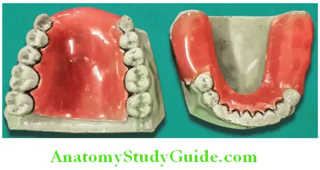 Fabrication Of Removable Partial Denture fabrication record base for removable partial denture