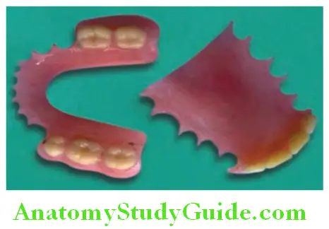 Fabrication Of Removable Partial Denture finished maxillary and mandibular partial dentures