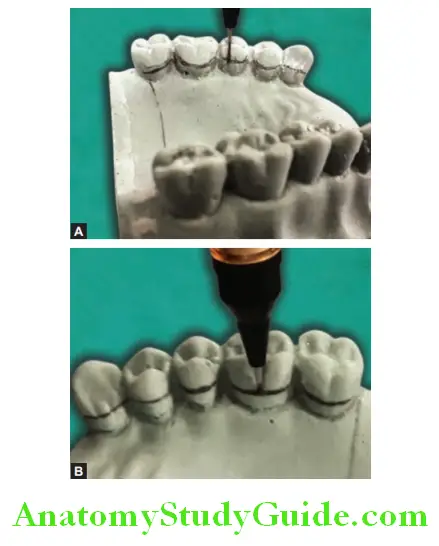 Fabrication Of Removable Partial Denture marking height of contour on remaining teeth