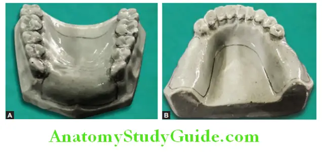 Fabrication Of Removable Partial Denture marking outline and application of cold mould seal