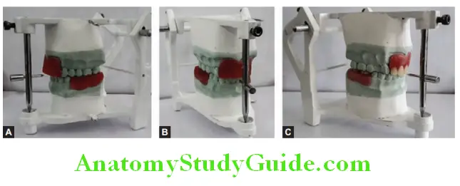 Fabrication Of Removable Partial Denture mounting casts on mean value articulator