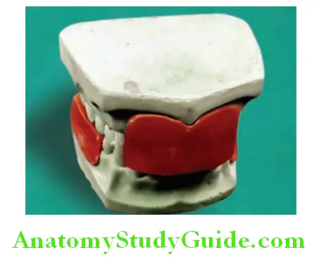 Fabrication Of Removable Partial Denture placing casts in occlusion