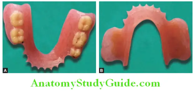 Fabrication Of Removable Partial Denture polished surface and tissue surface of mandibular partial denture