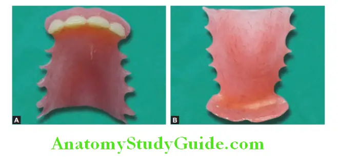 Fabrication Of Removable Partial Denture polished surface and tissue surface of maxillary partial denture
