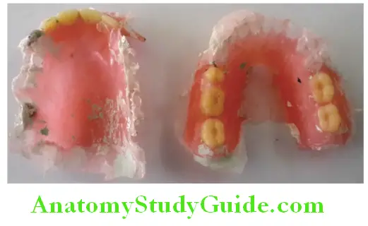 Fabrication Of Removable Partial Denture removable partial dentures retrieved from flasks