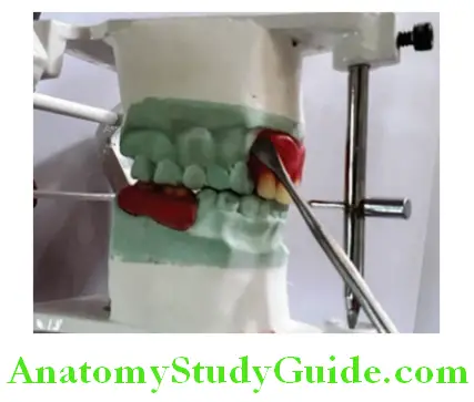 Fabrication Of Removable Partial Denture sealing of trial denture on the cast