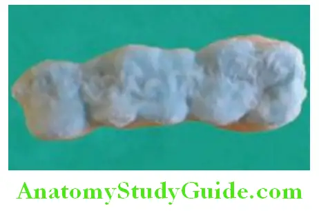 Fabrication Of Three Unit Fixed Partial Denture application of dentine and enamel layer of porcelain