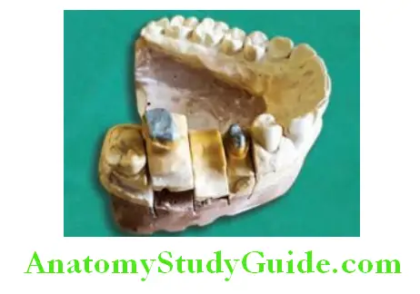 Fabrication Of Three Unit Fixed Partial Denture die preparation