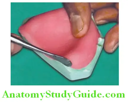 Fabrication of Denture Base Record Base adpt the material in the sulcus